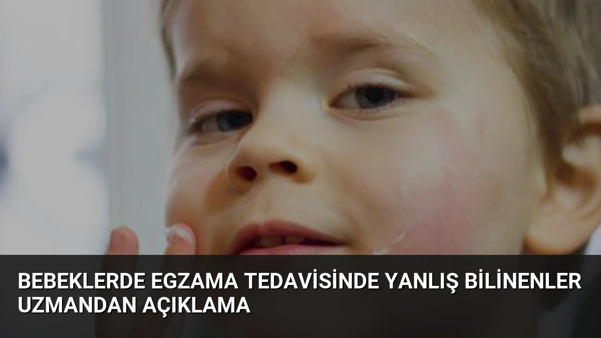 Bebeklerde Egzama Tedavisinde Yanlış Bilinenler Uzmandan Açıklama