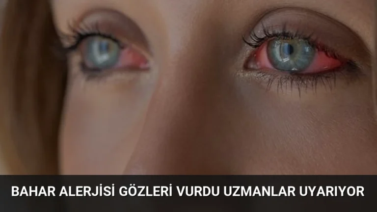 Bahar Alerjisi Gözleri Vurdu Uzmanlar Uyarıyor